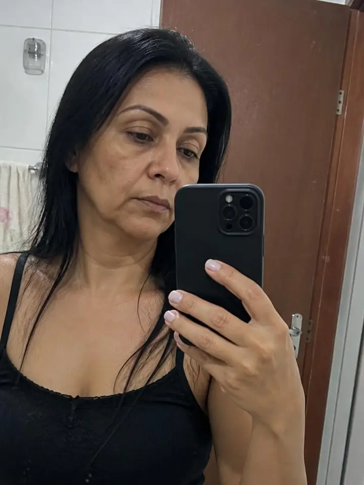 Renata Alves, 44 anos antes do tratamento com Pérolas de PDRN