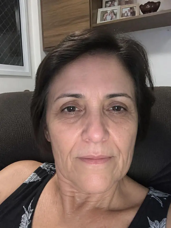 Vera Lúcia, 52 anos antes do tratamento com Pérolas de PDRN