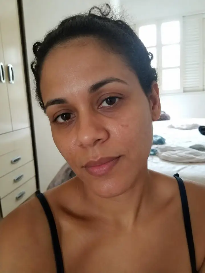 Camila Souza, 36 anos antes do tratamento com Pérolas de PDRN