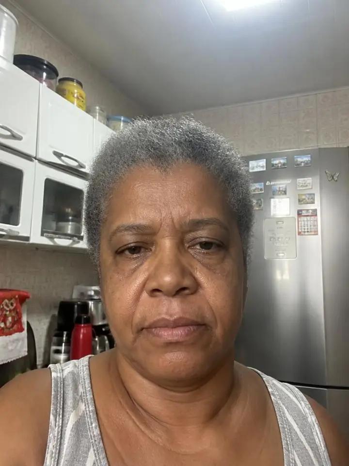 Dona Neide, 58 anos antes do tratamento com Pérolas de PDRN